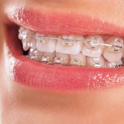 Dental Implant